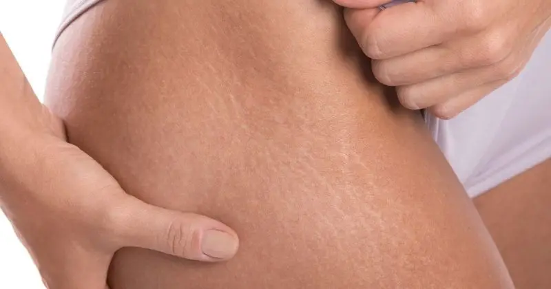 Stretch Marks After Weight Loss - Stretch marks on a female's thigh