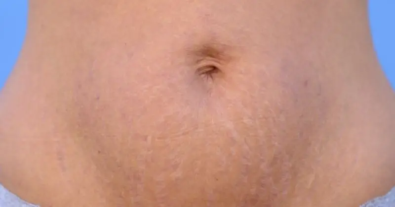 Stretch Marks After Weight Loss - Stretch marks on a tummy